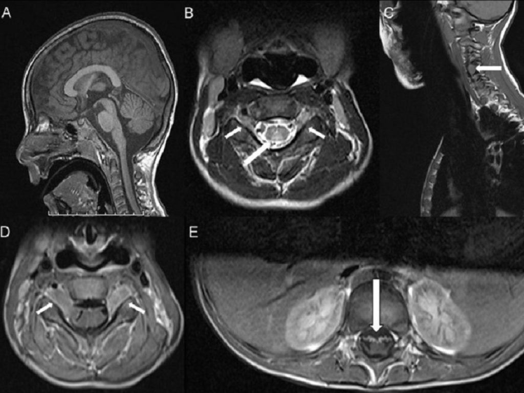 Deficit del trasportatore di riboflavina: nuova speranza da uno studio del Bambino Gesù. Cellule staminali aprono la strada a una possibile terapia con antiossidanti