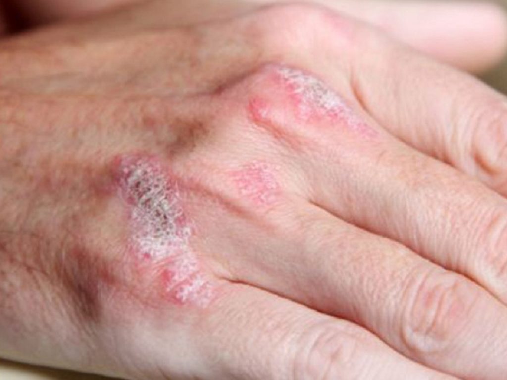 Dermatite atopica: upadacitinib bene da solo