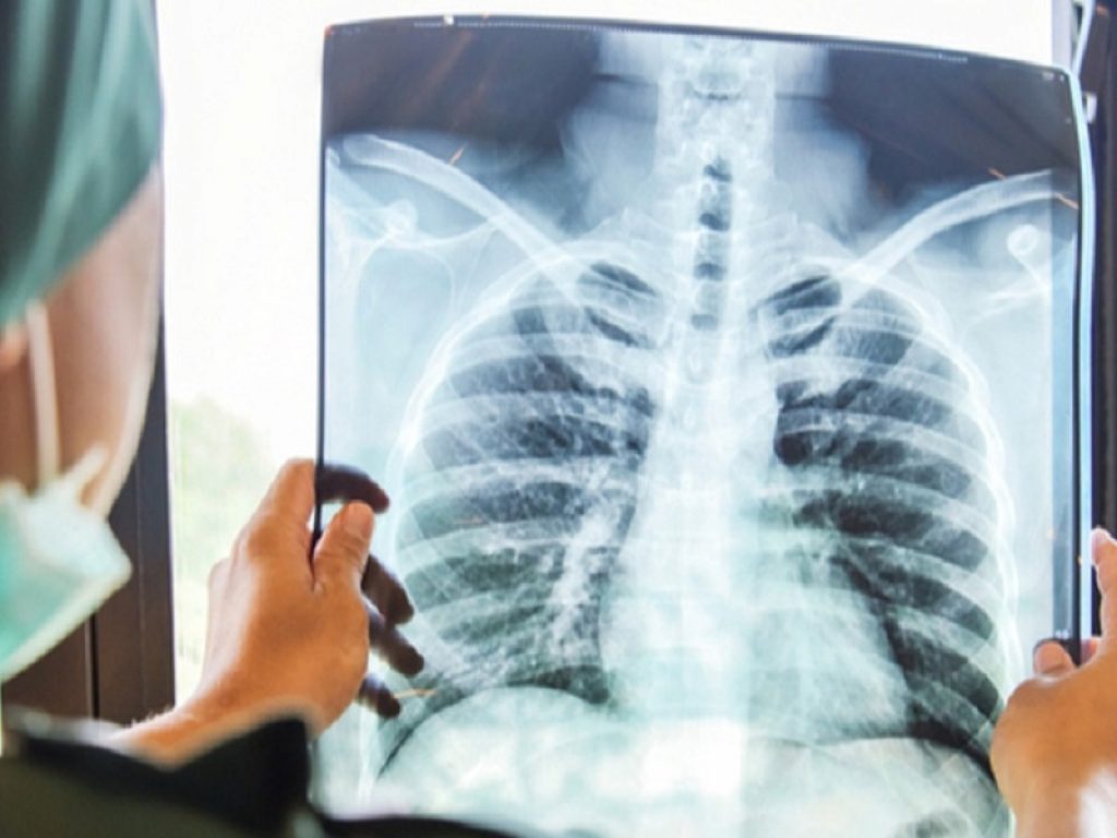 Le interstiziopatie sono complicanze polmonari che possono interessare alcuni pazienti con malattie reumatologiche autoimmuni: in Italia luci e ombre