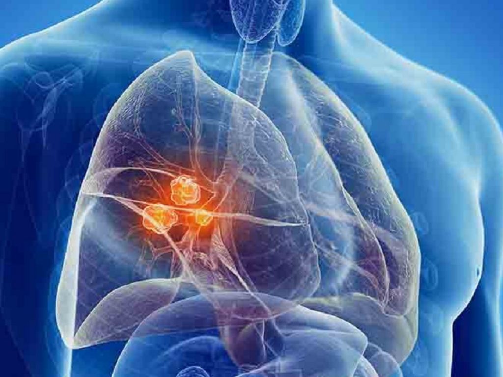 Tumore del polmone in stadio III: l'immunoterapia con il nuovo anti-PD-L1 sugemalimab allontana la progressione della malattia