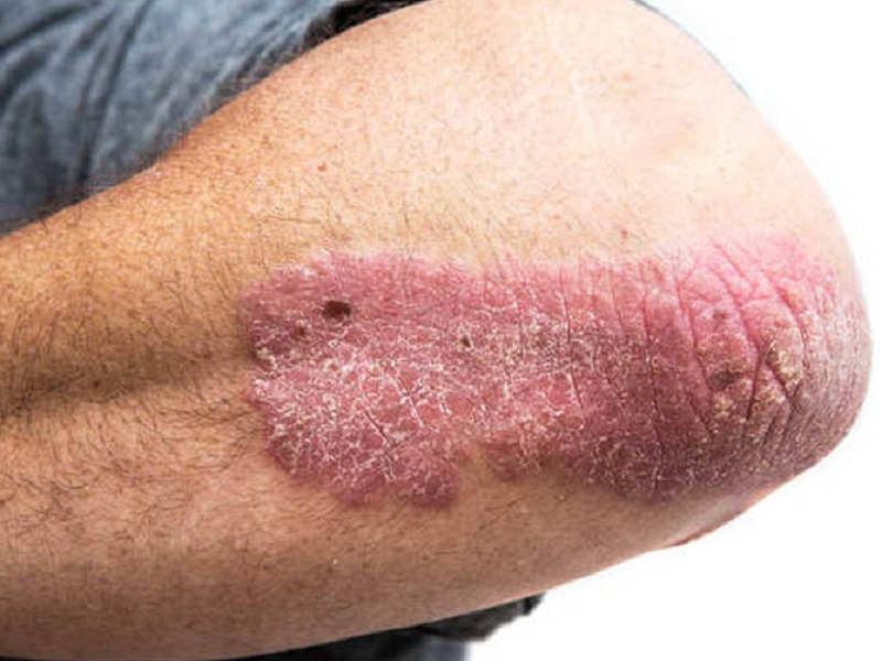Psoriasi bimekizumab
