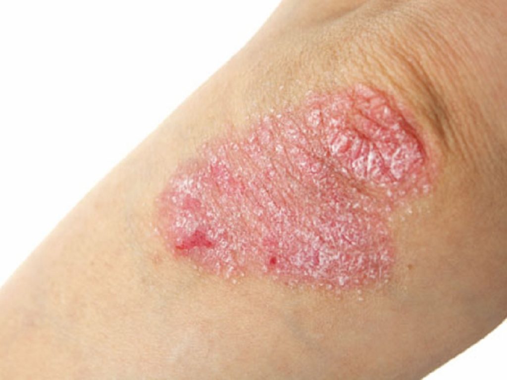 La presenza di uno stato di infiammazione subclinica potrebbe articolare la strategia terapeutica nei pazienti con psoriasi in due fasi