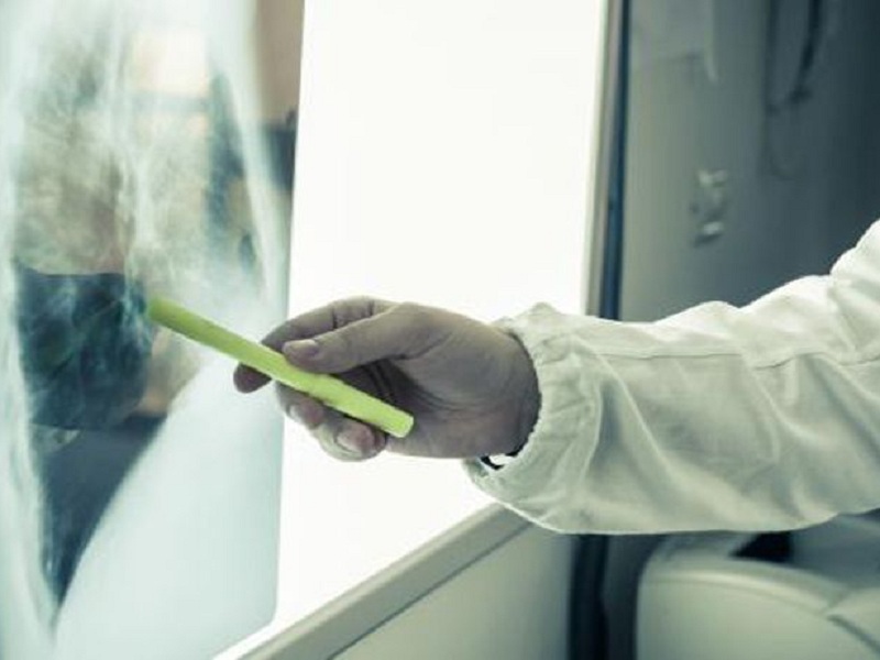 Tumore del polmone avanzato: l'aggiunta di sintilimab alla chemioterapia ritarda la progressione secondo i risultati di un nuovo studio