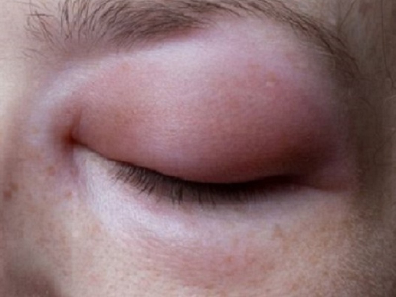 Angioedema ereditario, buoni risultati per lanadelumab-flyo