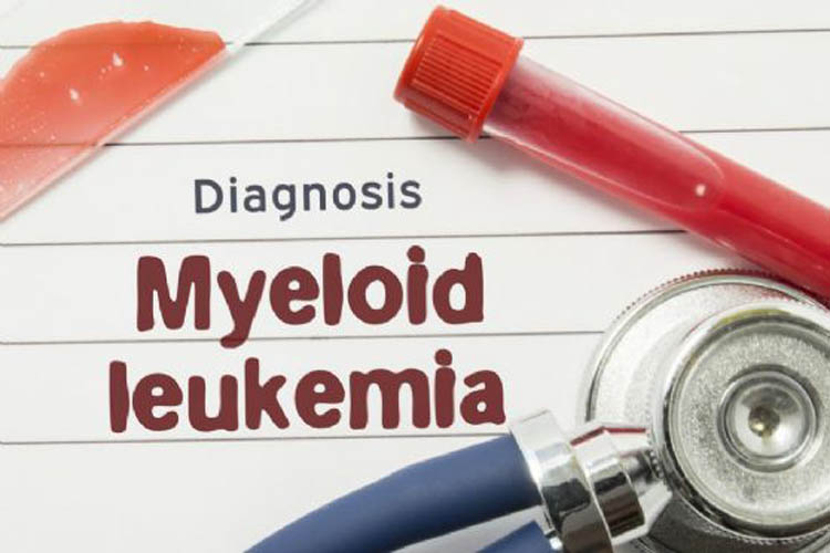 Leucemia mieloide: gilteritinib meglio della chemio