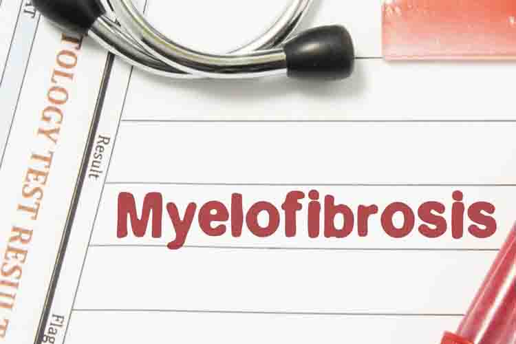 mielofibrosi