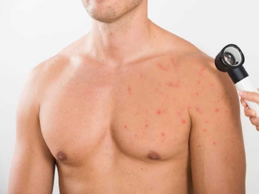 Acne del tronco: trifarotene disponibile in Italia