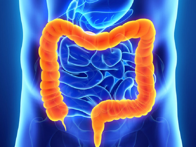 Diverticolite del colon, aggiornate le buone pratiche