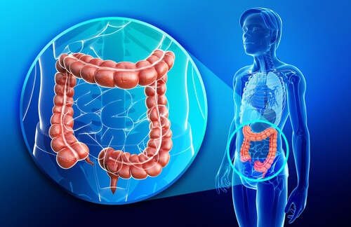 Secondo un nuovo studio la terapia farmacologica intensiva migliora l'infiammazione associata alla stenosi nella malattia di Crohn