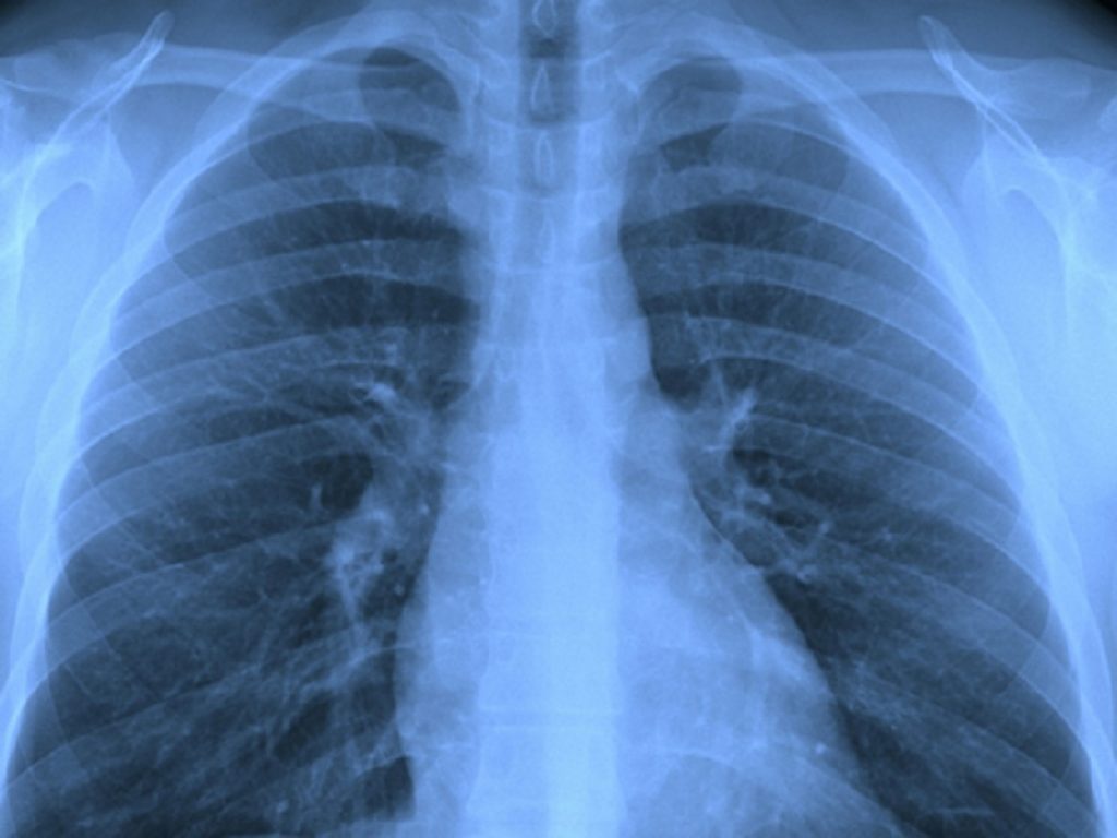Tumore del polmone: in Lombardia aumentano le diagnosi precoci. Ogni anno si registrano circa 7.800 nuovi casi