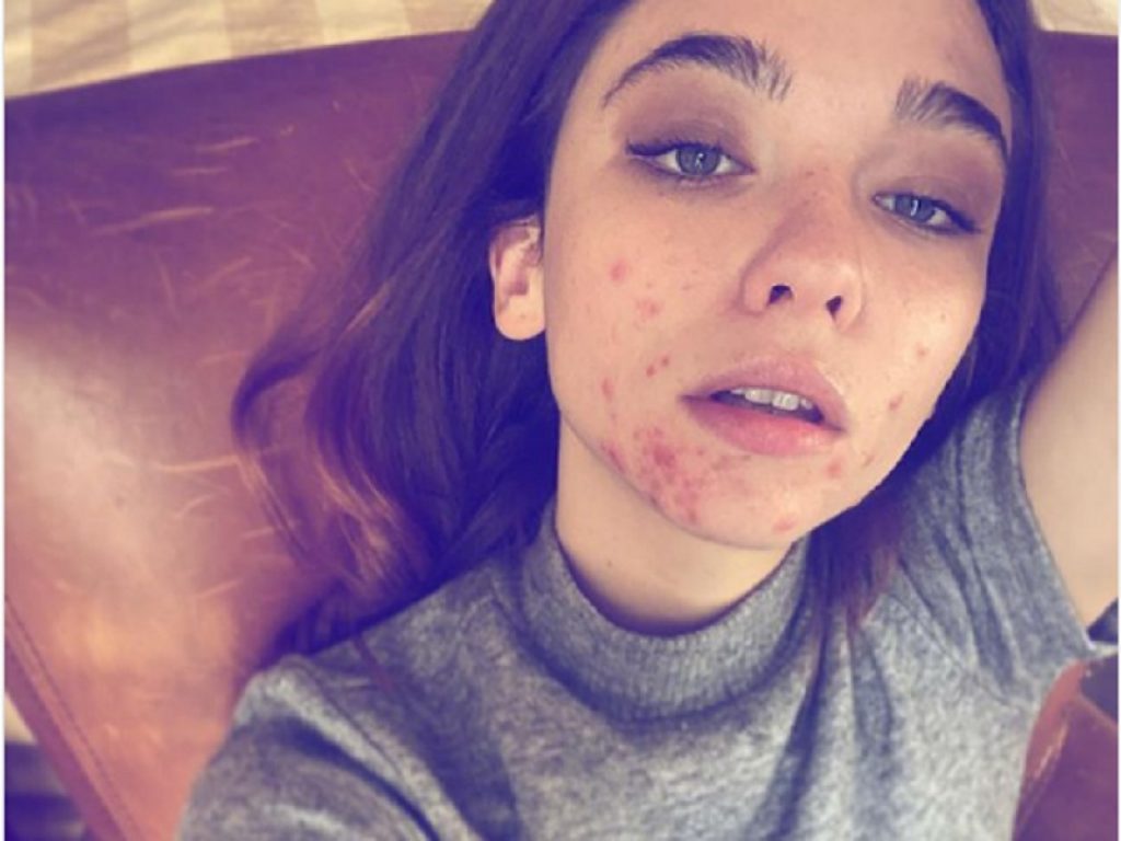 Matilda De Angelis si mostra con l’acne