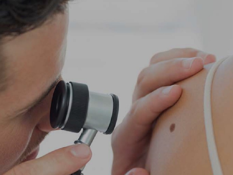 Melanoma avanzato: un nuovo approccio terapeutico basato sul trattamento con linfociti infiltranti il tumore può migliorare la sopravvivenza libera da progressione