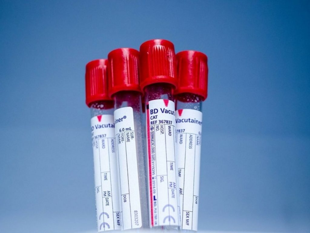 Tumore del polmone, il sangue aiuta a individuare i soggetti più a rischio: sviluppato un nuovo sistema per capire chi dovrebbe sottoporsi allo screening