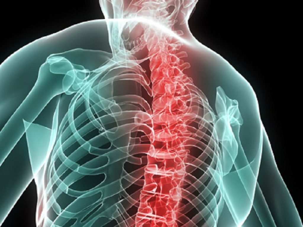 Spondilite: upadacitinib riduce il dolore nei pazienti