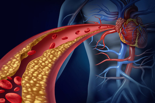 Nuovo studio sugli effetti del nuovo oligonucleotide antisenso pelacarsen su vari bersagli del colesterolo, tra cui il colesterolo LDLc