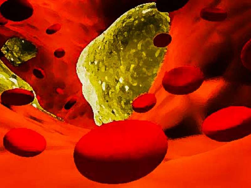 In pazienti con livelli elevati di lipoproteina, riduzione prolungata fino al 94% dopo 48 settimane con una singola iniezione di lepodisiran