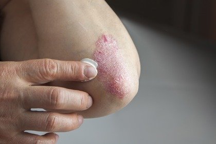 Artrite psoriasica oligoarticolare, monoterapia con apremilast efficace