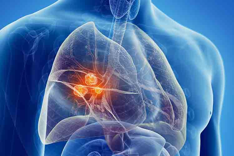 Carcinoma polmonare non a piccole cellule metastatico: maggiore sopravvivenza con la triplice terapia in presenza di mutazioni ad alto rischio