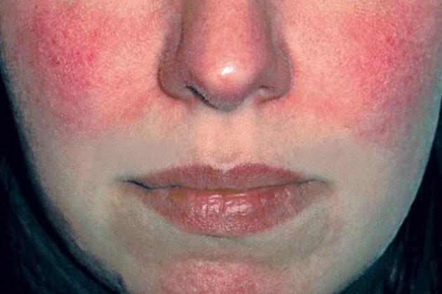 Per il trattamento della rosacea papulo-pustolosa: al via studi di fase III per DFD-29, una nuova formulazione a rilascio modificato di minociclina