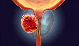 Tumore della prostata: darolutamide più terapia di deprivazione androgenica e docetaxel aumenta significativamente la sopravvivenza globale nei pazienti con malattia metastatica ormonosensibile