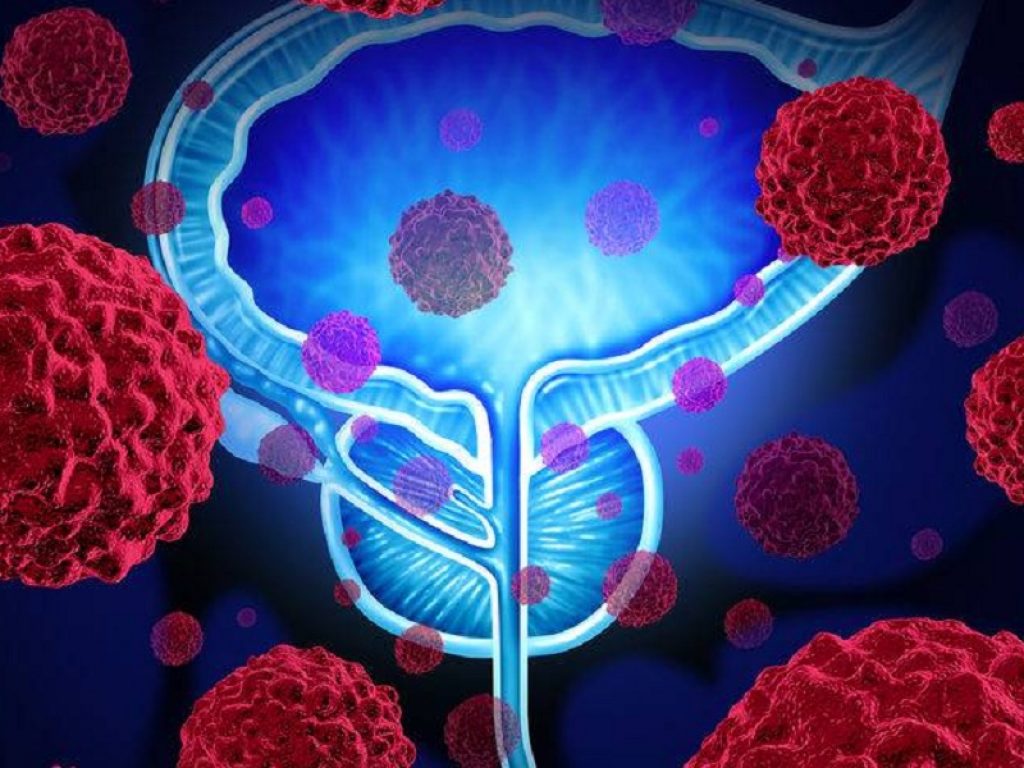 L’ecografia multiparametrica potrebbe essere utilizzata in alternativa alla risonanza magnetica come primo test in pazienti a rischio 