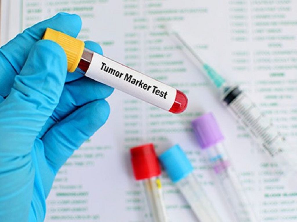 Carcinoma mammario avanzato HR+/HER2-: per ribociclib arrivano nuove conferma sulla sua efficacia a lungo termine