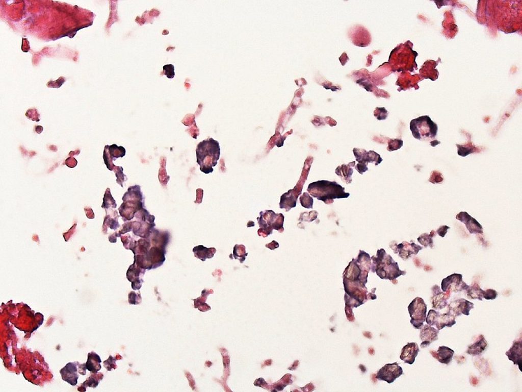 Aspergillosi invasiva: buoni risultati con posaconazolo