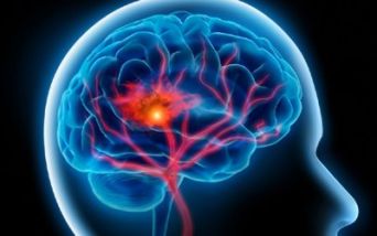 L'ictus cerebrale ogni anno in Italia colpisce 150mila persone: si tratta di una patologia tempo-dipendente, importante è riconoscere i sintomi