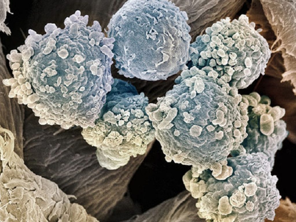 Sclerosi multipla: ocrelizumab riduce l'infiammazione