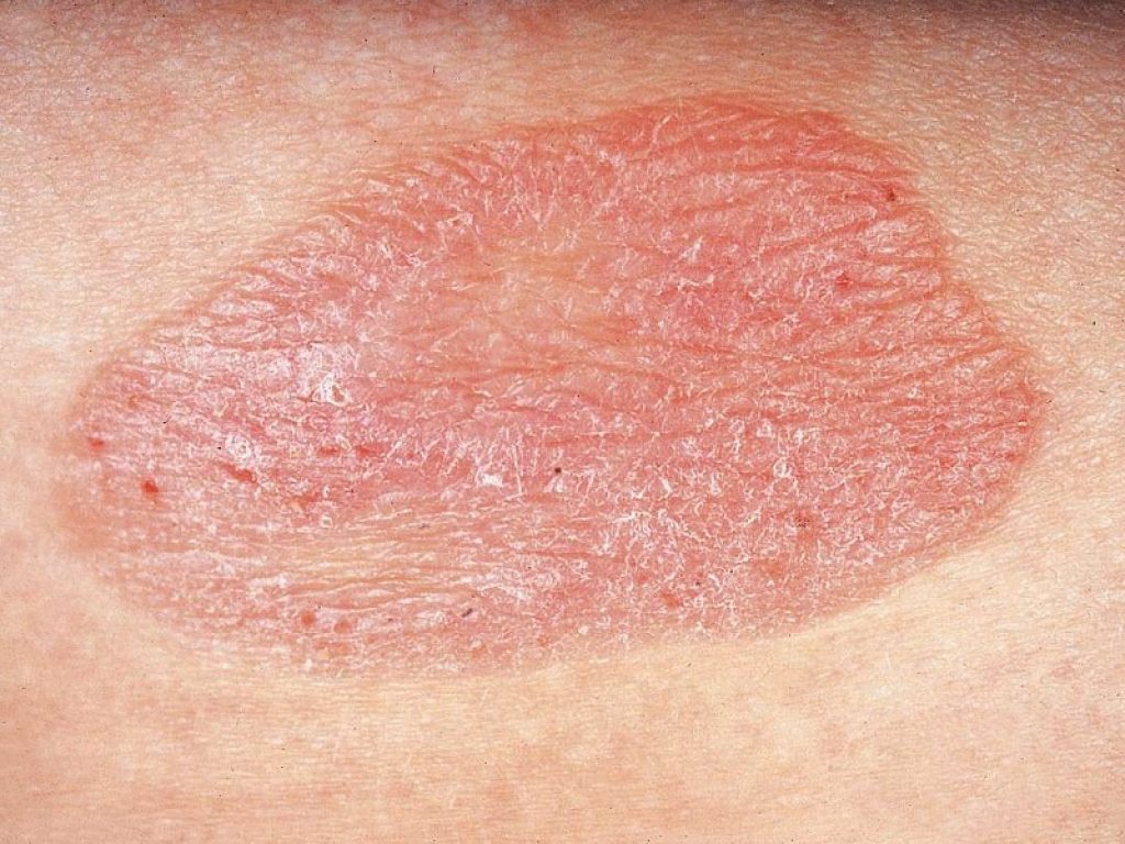 Micosi fungoide e sindrome di Sézary: stimato l'impatto in Italia