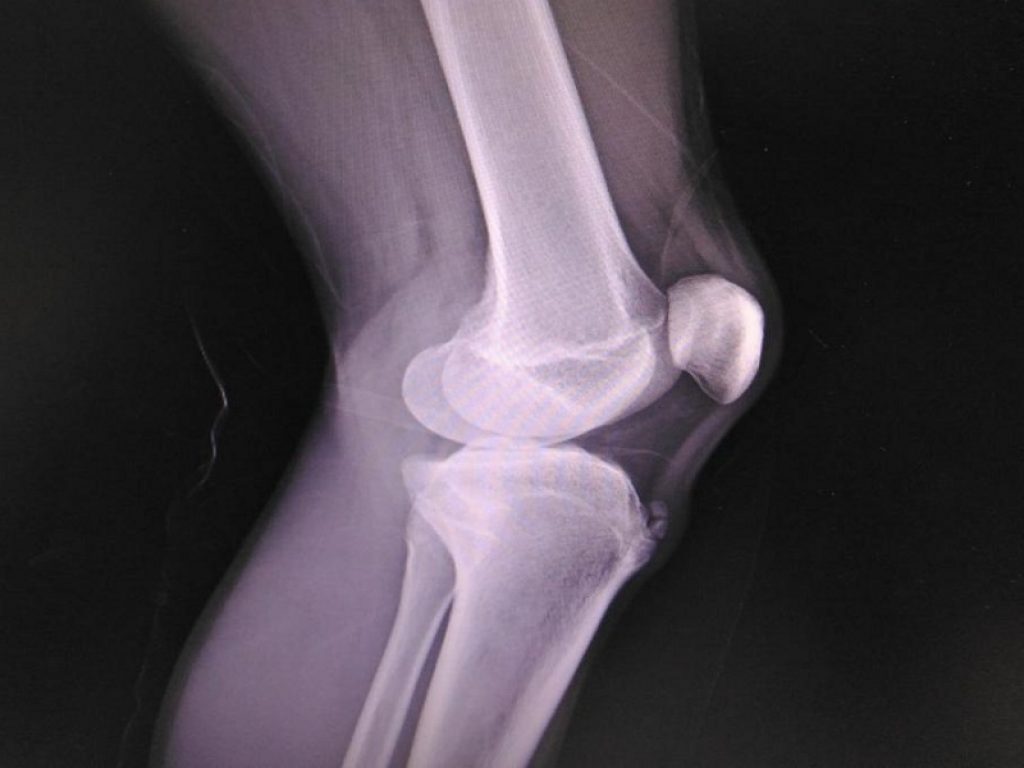 Sindrome di Osgood-Schlatter: le conseguenze da adulti