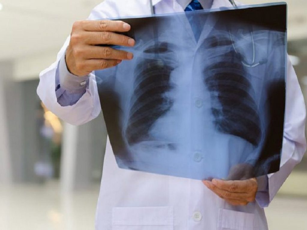 Una TC polmonare che può essere usata per la diagnosi precoce del cancro al polmone potrebbe svelare anche lo stato di salute di cuore e vasi