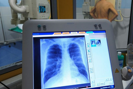 Livelli elevati di uricemia (SUA) sono associati ad un deterioramento della funzione polmonare, soprattutto nei pazienti con Bpco