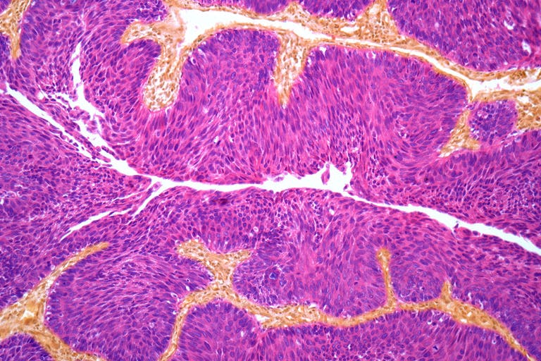 Tumore alla vescica: così agisce la mitomicina C