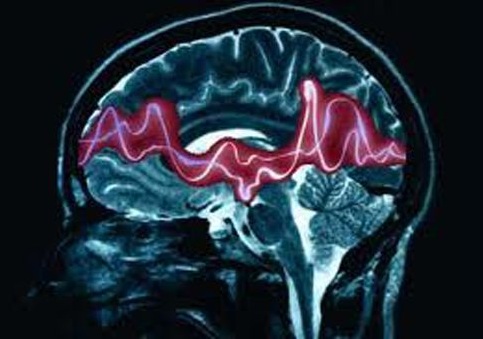 Epilessia: nuovi studi dimostrano efficacia e tollerabilità del farmaco brivaracetam in popolazioni particolarmente fragili