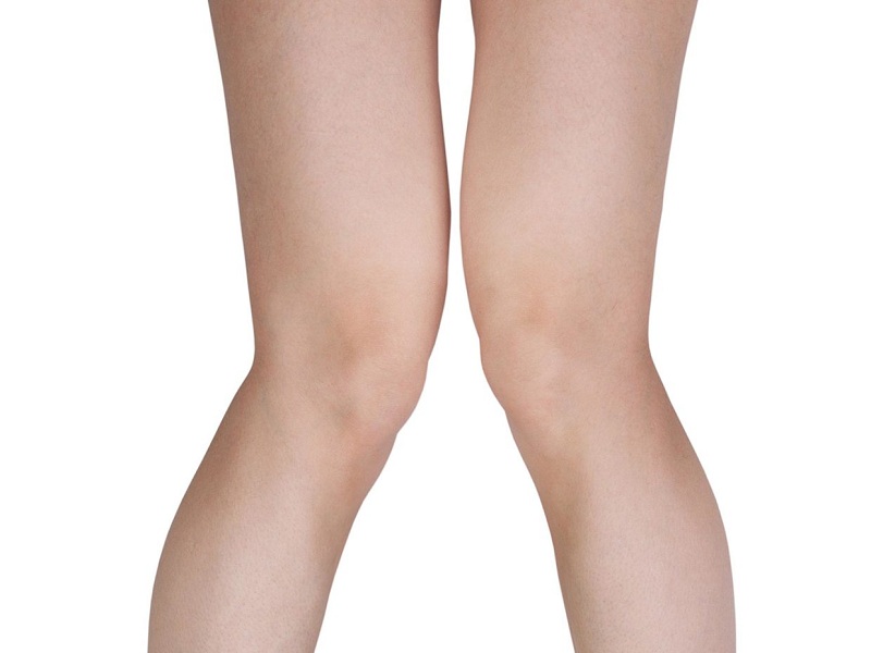 Varismo e valgismo: ecco quando serve la protesi