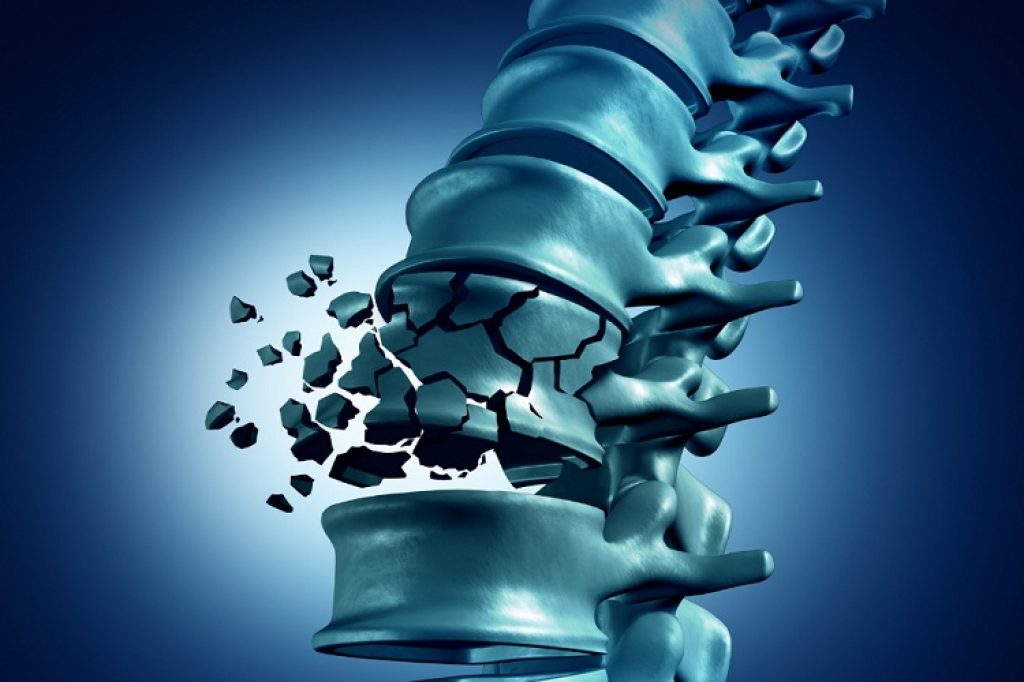 Paracetamolo e codeina sono efficaci quanto ossicodone per il controllo del dolore dopo la riduzione chirurgica di una frattura