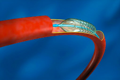 Dopo un mese dall'intervento coronarico percutaneo (PCI) per infarto miocardico è preferibile il passaggio da ticagrelor a clopidogrel
