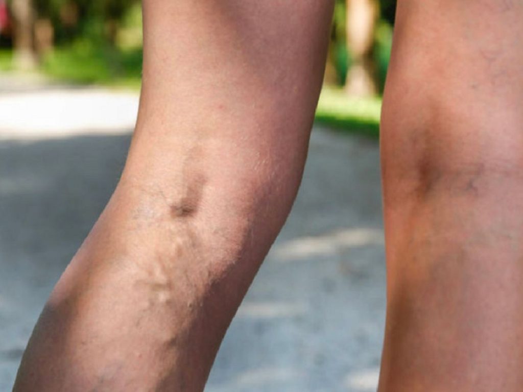 Trombosi venosa profonda: ecco quali sono i principali fattori di rischio, i sintomi e le cure per i pazienti affetti da questa patologia