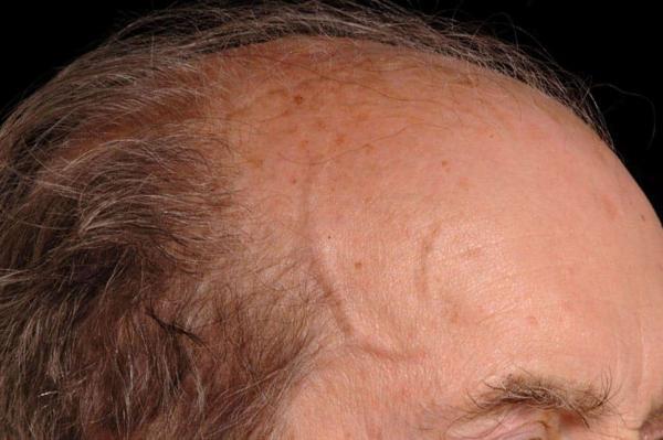 Arterite a cellule giganti, salute