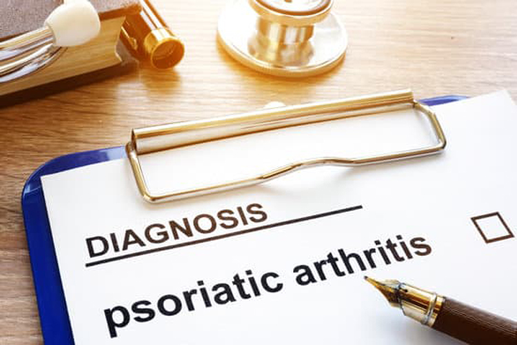 Diagnosi di artrite psoriasica, salute, apremilast