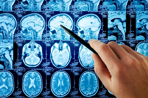 Chemioimmunoterapia efficace nei pazienti affetti da carcinoma polmonare non a piccole cellule non squamoso in stadio avanzato con metastasi cerebrali non trattate