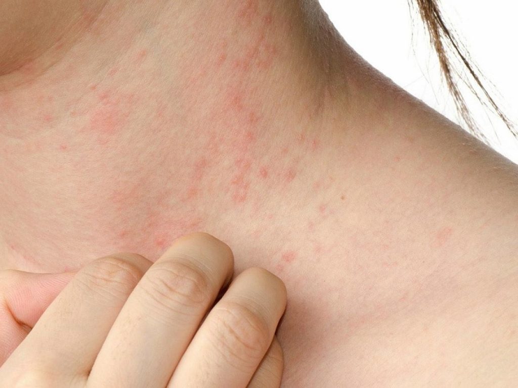 Orticaria, dermatologia, pioderma