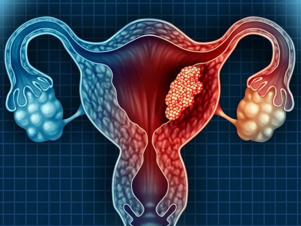 Carcinoma ovarico avanzato e recidivato, BRCA-mutato: l'inibitore di PARP rucaparib ha migliorato significativamente la sopravvivenza libera da progressione