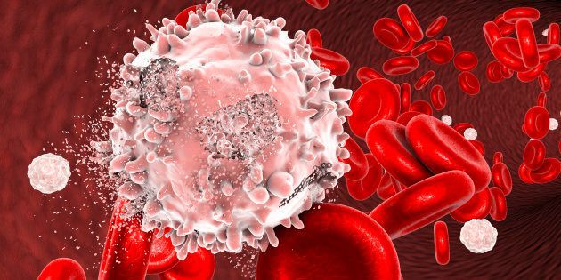 Leucemia linfoblastica acuta: la Commissione Europea ha approvato la terapia a base di cellule CAR T brexucabtagene autoleucel
