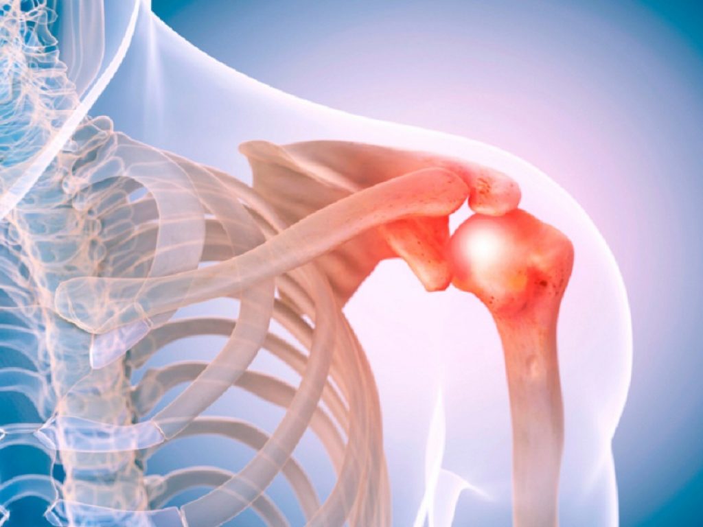 Plessopatia brachiale spalla