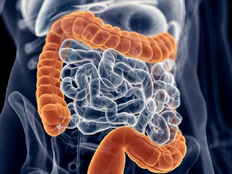 Tumore al colon, mutazioni geniche nanosistema