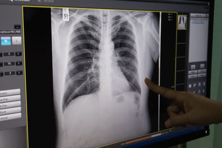 Tumore al polmone, tarlatamab nivolumab pralsetinib