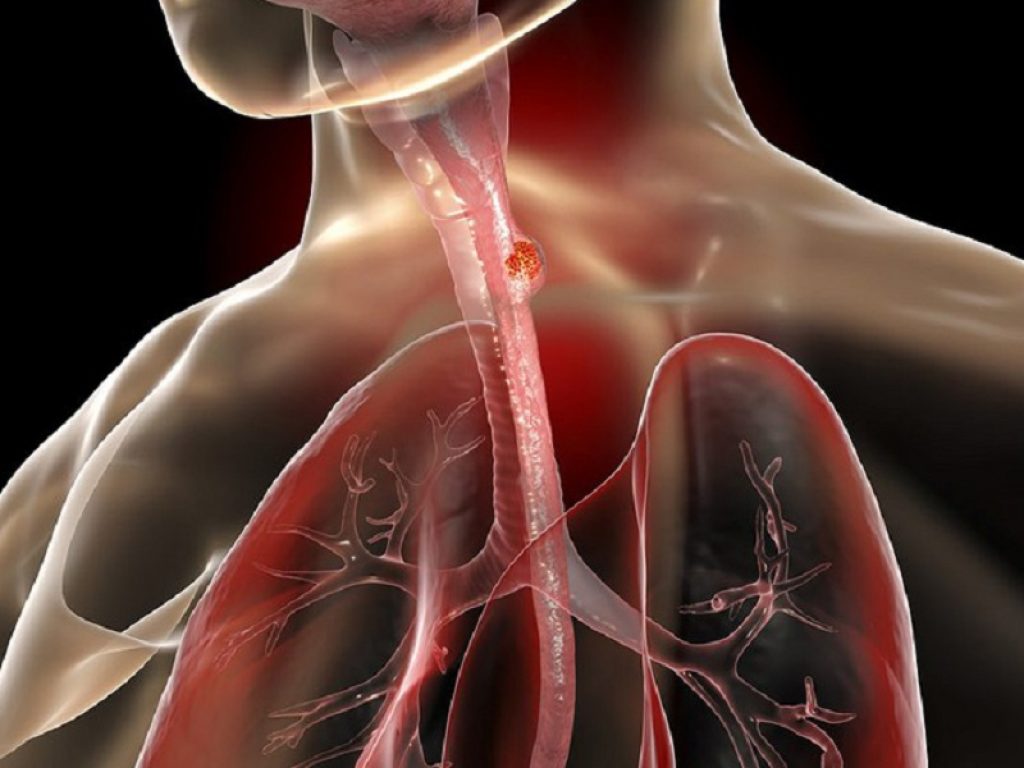 Tumore all'esofago: sì a nivolumab dopo CRT