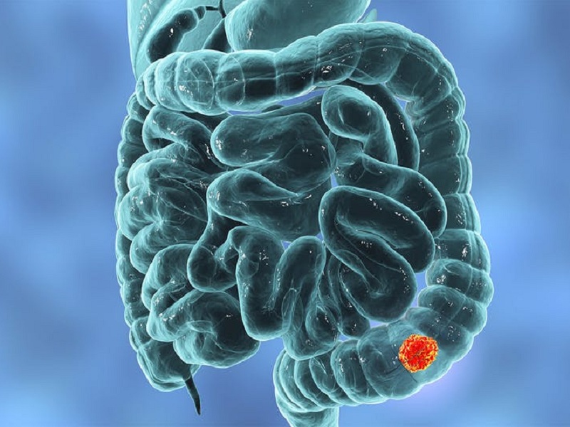 Tumore al colon: benefici dall'impiego di farmaci mirati ai sistemi di risposta al danno del DNA che nelle cellule tumorali in parte risultano difettosi